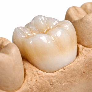 Layered Zirconia / Porcelain