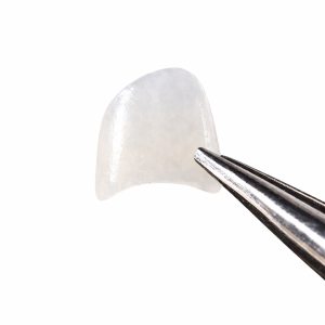 No-Prep Esthetic Veneer (Lithium Disilicate)
