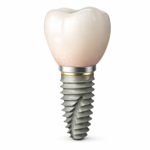 Temporary Implant Crown (All parts included)